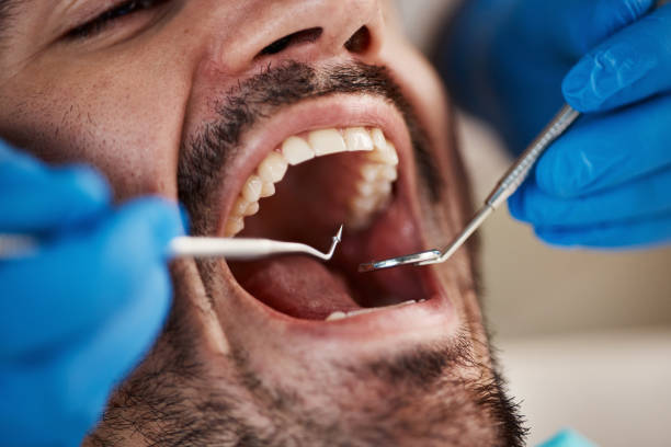 Best Emergency Treatment for Dental Infections or Abscesses in Lakeside, CA